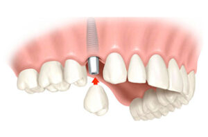 implante simple unitario mejor clinica de implantes dentales en vilamarxant