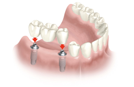 protesis fija sobre implantes mejor clinica dental en vilamarxant