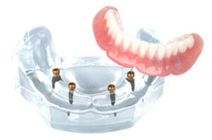 protesis removible sobre 4 implantes mejor clinica de implantes dentales en vilamarxant